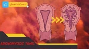 Adenomyosis tamil